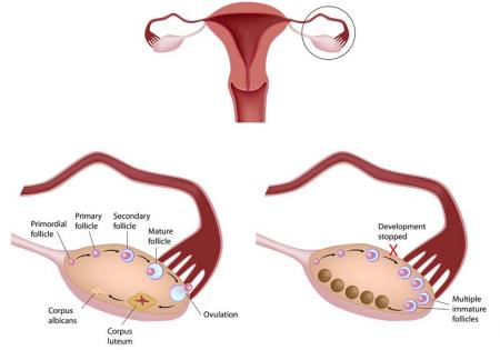 PCOS and IVF