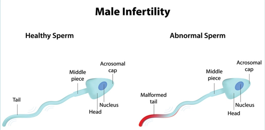 male infertility chart